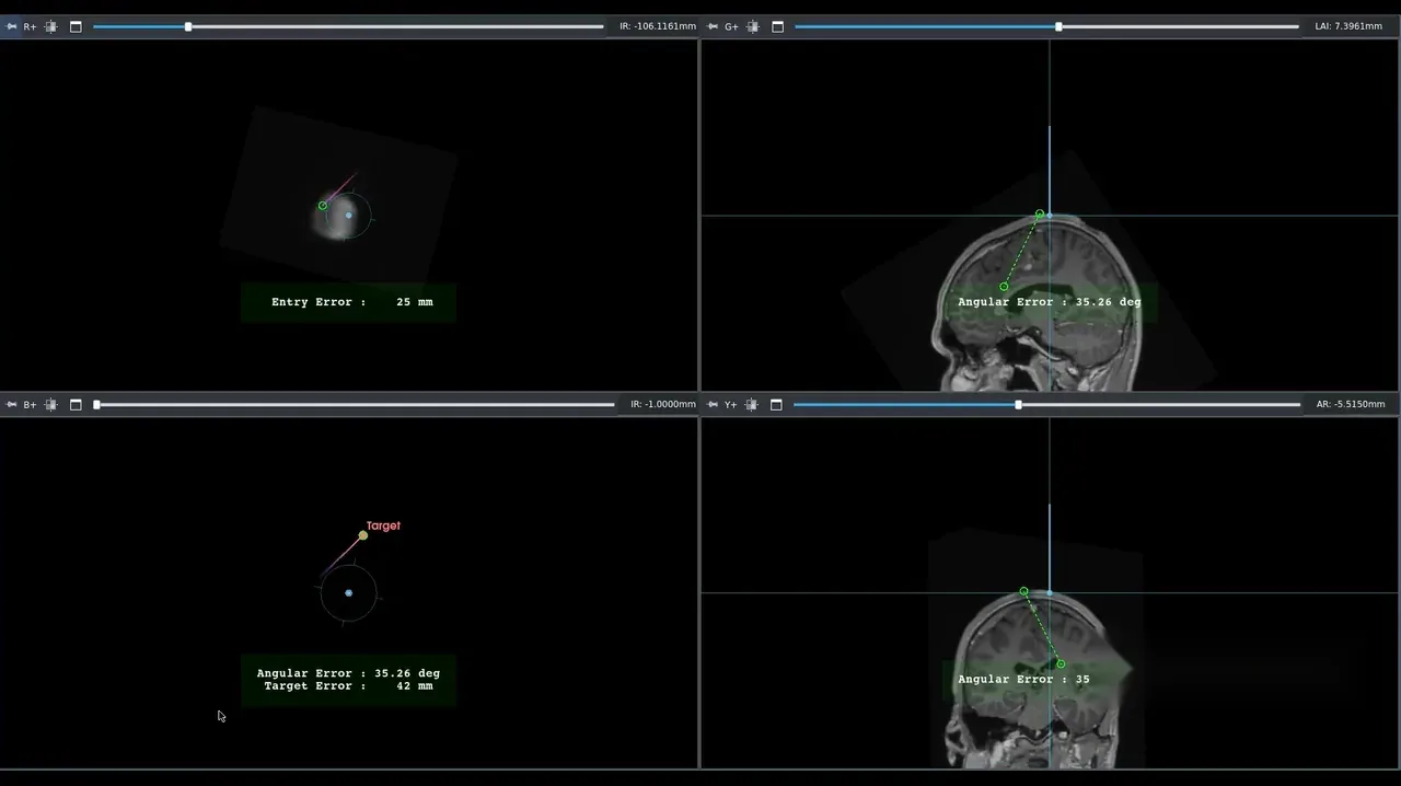Navigation view: bullseye entry and depth guidance beside reformatted planes.